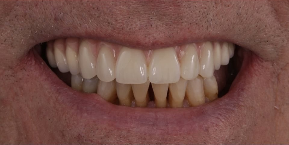 Jake after dental implants