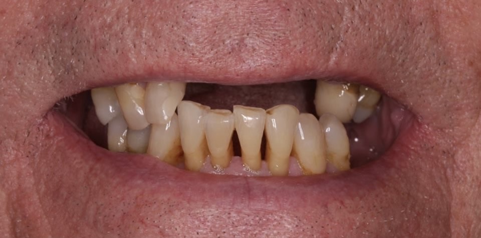 Jake before dental implants