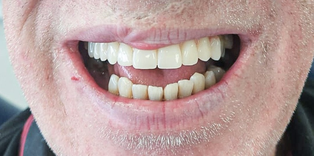 Robert after dental implants