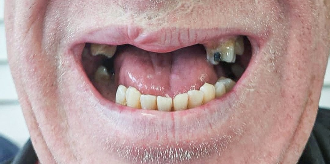 Robert before dental implants