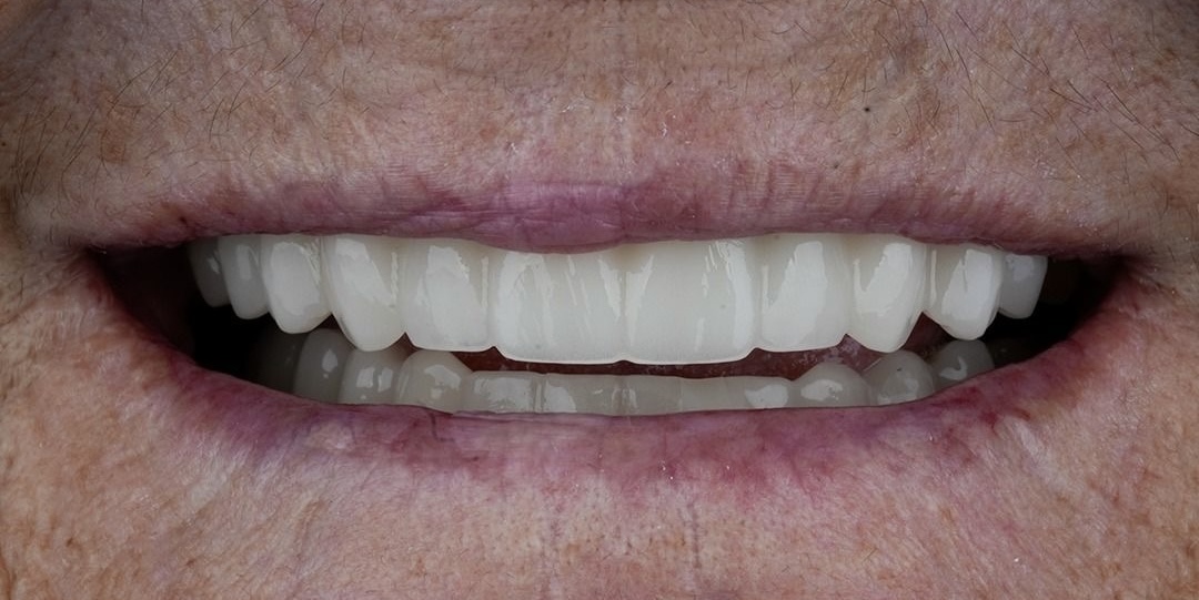 Linda after dental implants