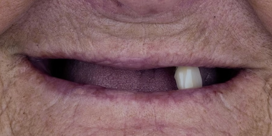 Linda before dental implants