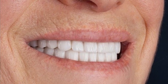 Margaret after dental implants