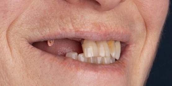 Margaret before dental implants