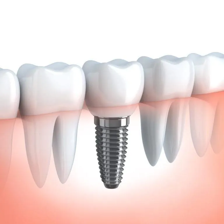Single Implant