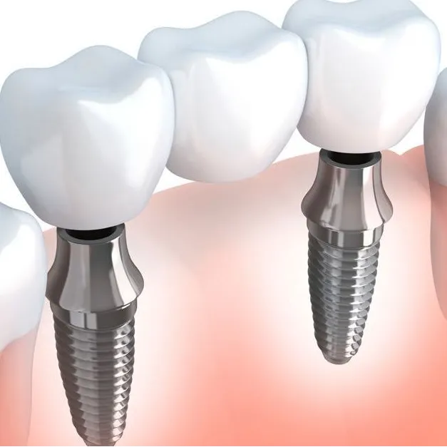 Implant Secured Bridge
