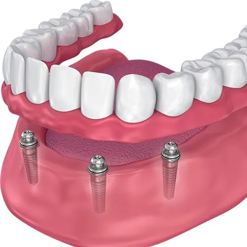 Implant Secured Denture