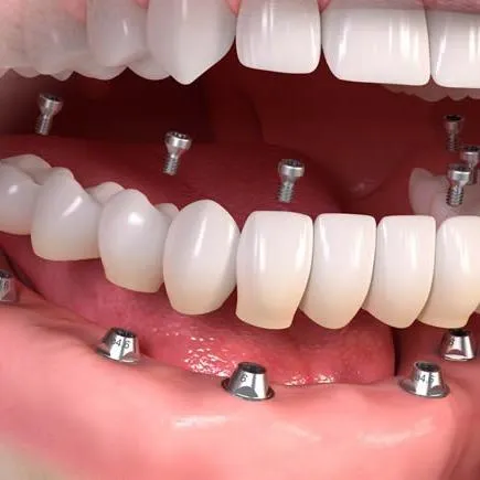 Full Fixed Arch