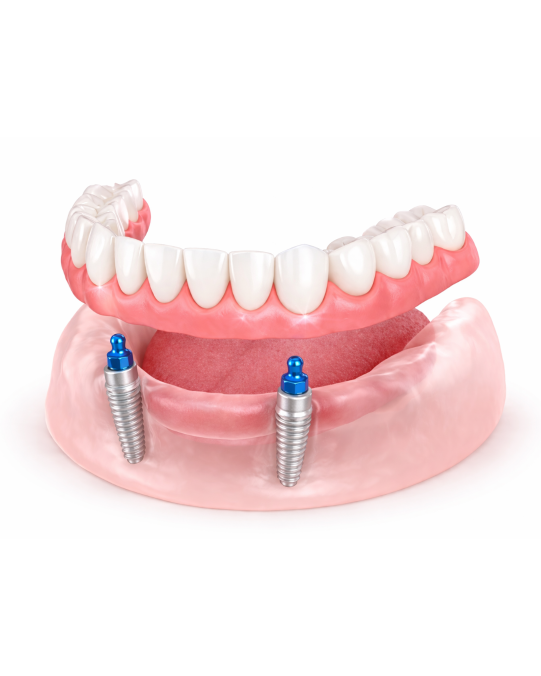 Snap-In Denture