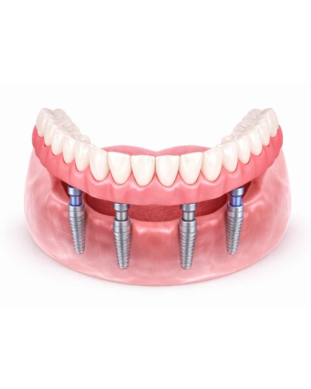 Full Arch Implants