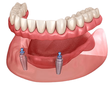 Premium Zirconia Restoration - Full Mouth
