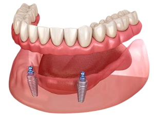 2 Implant Retained Overdenture