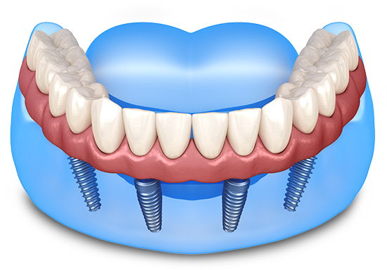All-On-4 Dental Implants Single Arch