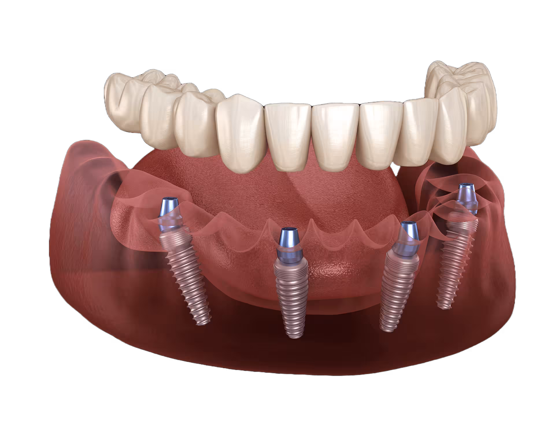 Permanent Zirconia Teeth Single Arch