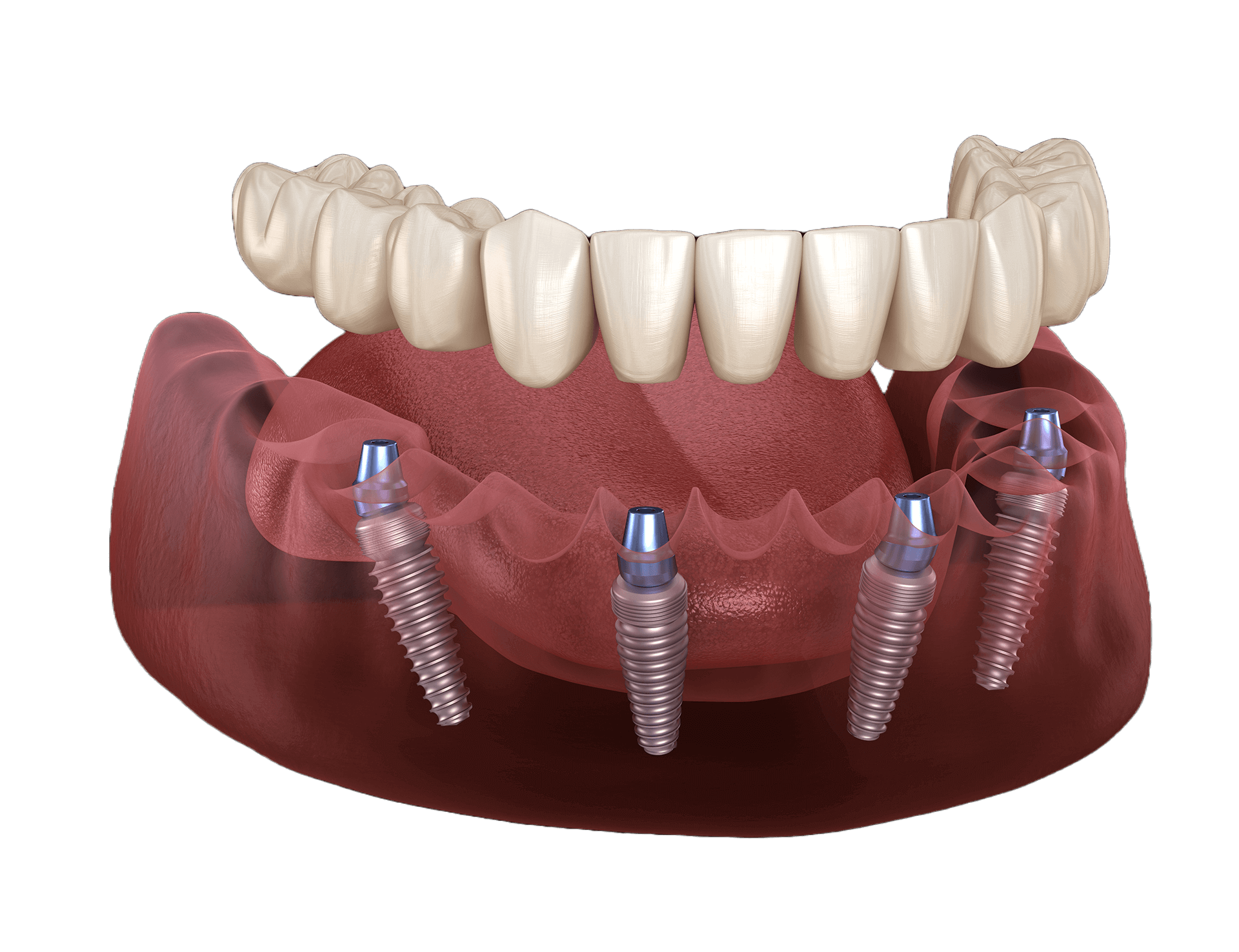 Permanent Zirconia Teeth Single Arch