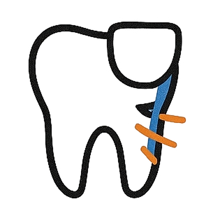 Porcelain Veneers Chips, Gaps, Stains