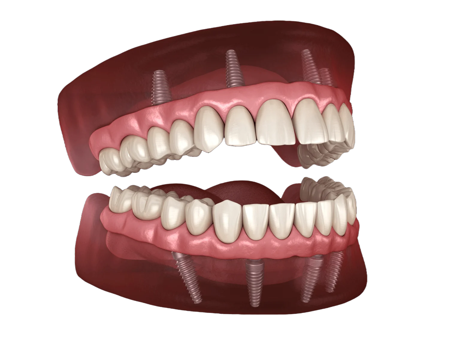 Permanent Zirconia Teeth Double Arch