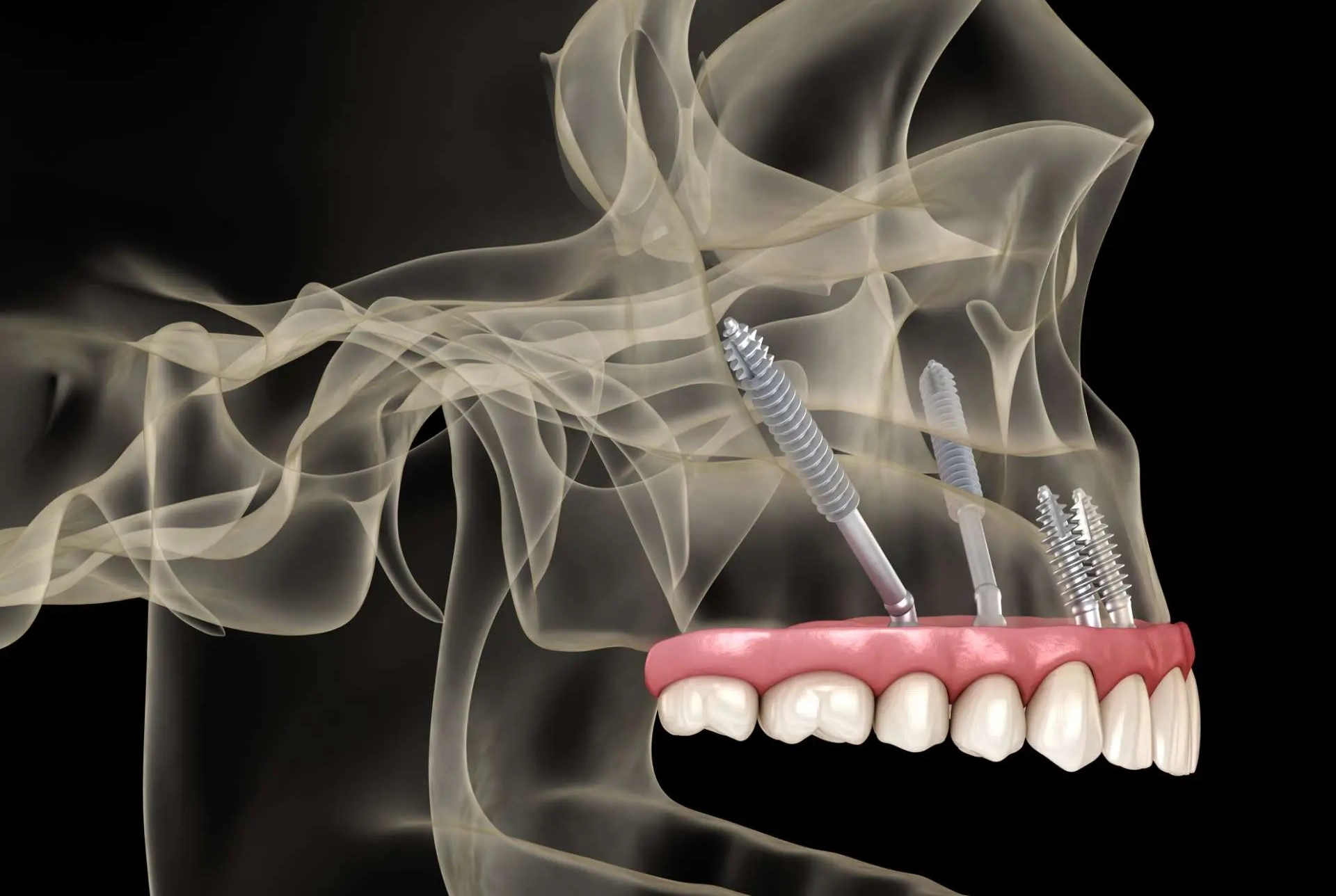 Zygomatic Dental Implants near Boca Raton FL